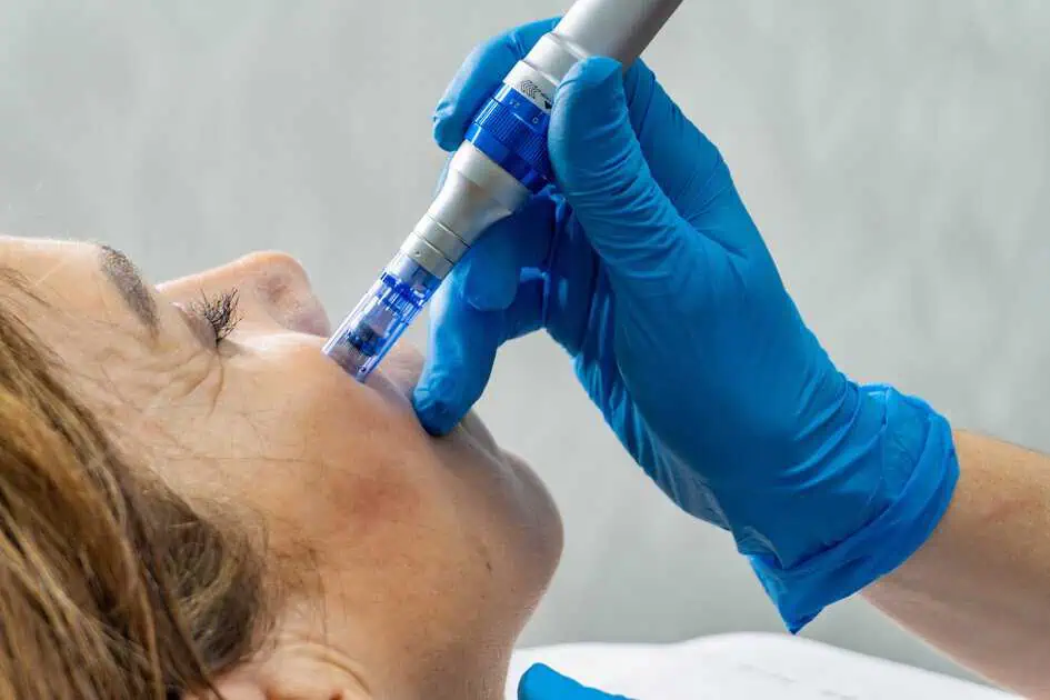 Close-up of a woman receiving acne scar treatment in Morristown, TN