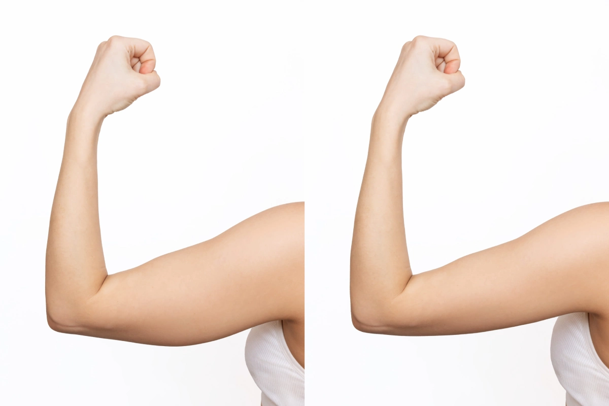 Woman showing before-and-after results of sculpted, firmer upper arms after EvolveX Tone treatment.
